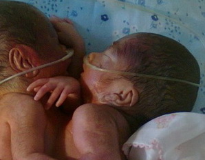 Bayi kembar siam dempet kepala butuh bantuan