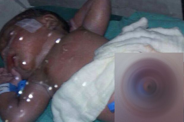 Lahir dengan Usus di Luar Perut, Bayi Ini Butuh Bantuan Biaya Operasi